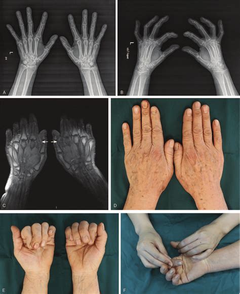 Dislocation Of The Metacarpophalangeal Joint Of The Index, 41% OFF