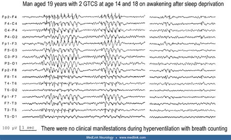 Asymptomatic generalized discharges in epilepsy with GTCS alone (video-EEG) | MedLink Neurology