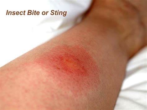 Insect Bites And Stings - Health And Medical Information