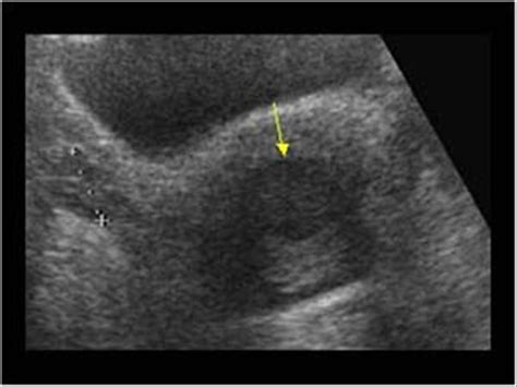 Gynaecology | 3.1 Uterus : Case 3.1.2 Miscellaneous benign uterine and cervical lesions ...