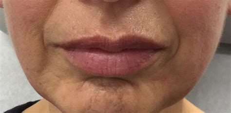 Dermal Fillers For Lip Lines Before And After | Sitelip.org