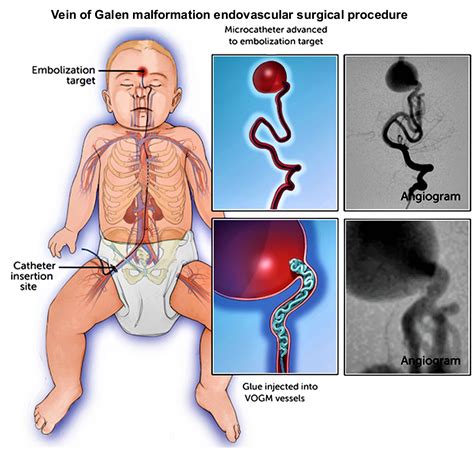 Vein of Galen malformation causes, symptoms, diagnosis, treatment & prognosis