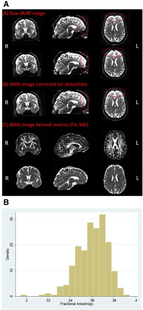 Diffusion MRI - analysis pipeline and initial results for fractional ...