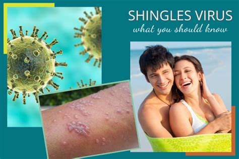 Shingles Symptoms