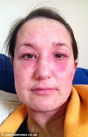 Eczema sufferer is hospitalised after using too much steroid cream ...