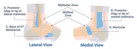 Ottawa Ankle Rules: When to Order an Ankle X-Ray - MedBridge Blog