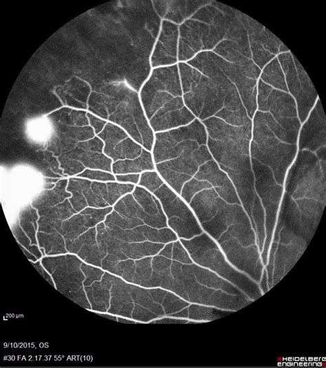 Sickle Cell Retinopathy - Retina Image Bank