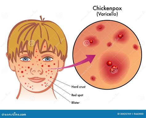 Chickenpox Cartoons, Illustrations & Vector Stock Images - 940 Pictures to download from ...