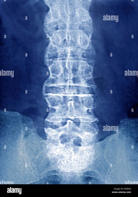 ANKYLOSING SPONDYLITIS, X-RAY Stock Photo - Alamy