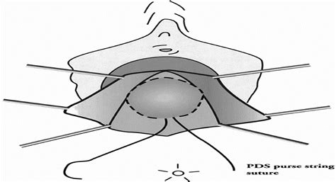 Fascial Posterior Colpoperineorrhaphy: A Five Year Follow-Up ...