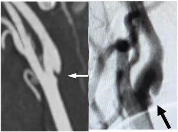 Symptomatic Carotid Web Requires Aggressive Intervention - Journal of ...