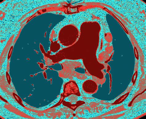 Echocardiographic Ratio Shows Pre- and Post-Capillary Pulmonary Hypertension - Pulmonology Advisor