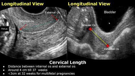 How To Measure Cervical Length On Ultrasound | Transabdominal And Transvaginal Views | Cervix ...