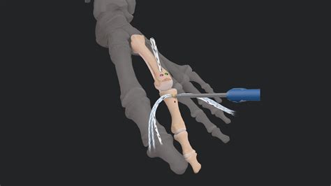 Arthrex - Simplifying the Plantar Plate Repair