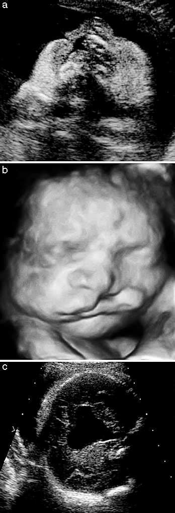 Holoprosencephaly Ultrasound