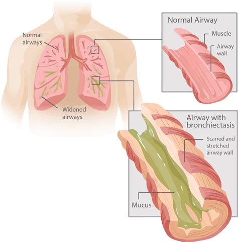 Airway Mucus Function And Dysfunction NEJM, 45% OFF