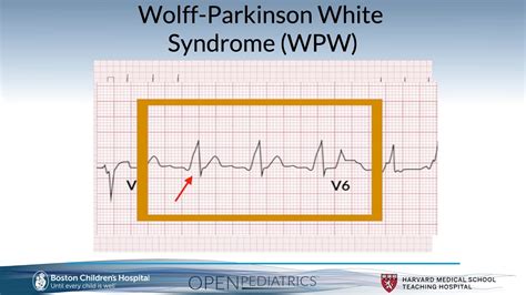 "Wolff-Parkinson-White Syndrome" by Dr. Gary Dhillon for OPENPediatrics - YouTube