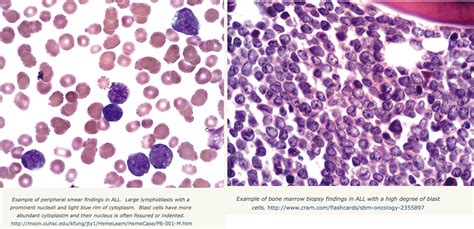 Acute Lymphoblastic Leukemia Bone Marrow Biopsy