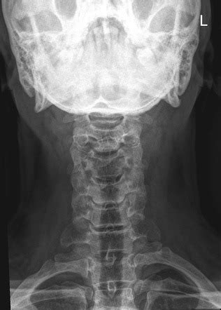 Cervical degenerative spondylosis | Image | Radiopaedia.org