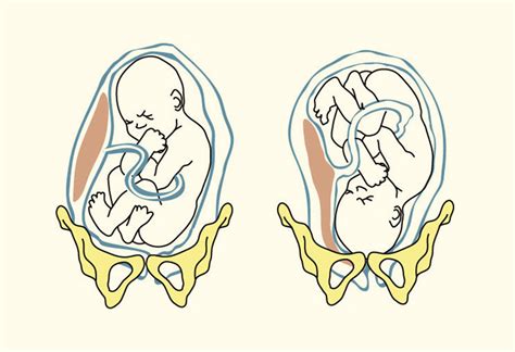 External Cephalic Version(ECV) : Procedure, Risks & Success Rate