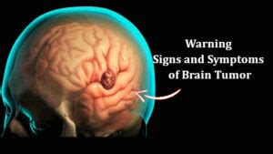 Early Signs and Symptoms of Brain Tumor in Women and Men