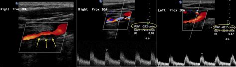 Carotid Stenosis - Radiology at St. Vincent's University Hospital