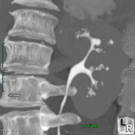 Necrosis papilar renal - EcuRed