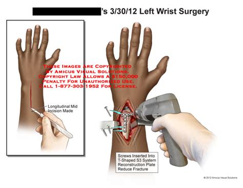 Left Wrist Surgery