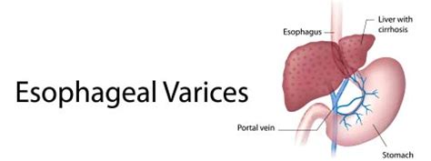 Esophageal Varices Pathophysiology