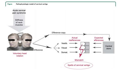 Stages Of Cervicogenic Dizziness Management | lupon.gov.ph