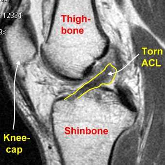 Automate the diagnosis of Knee Injuries 🏥 with Deep Learning part 1: an ...