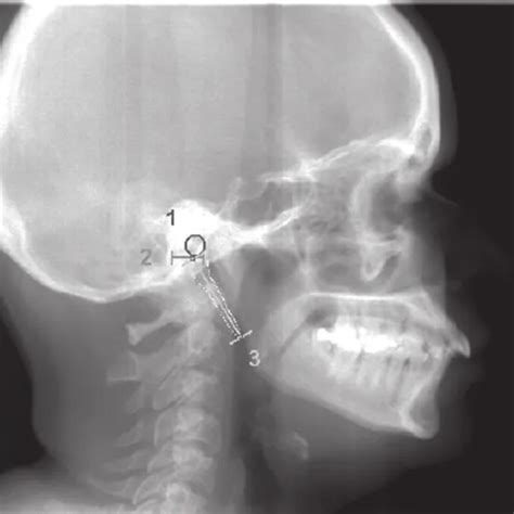 X-Ray Styloid Processes | Test Price in Delhi | Ganesh Diagnostic