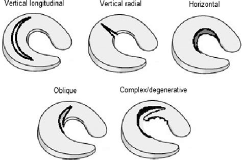 Diagram to illustrate the types of meniscal tears | Download Scientific Diagram