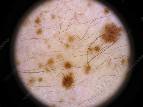 Nevus spilus - Stock Image - C006/4037 - Science Photo Library