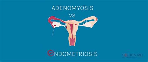 Endometriosis vs. Adenomyosis - Seckin Endometriosis Center