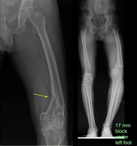 Malunion in the Lower Limb - OrthoInfo - AAOS