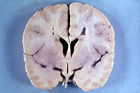 Symptoms, causes and treatment for Alexander disease | General center | SteadyHealth.com