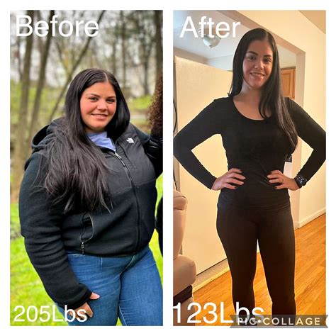 Fanny Loses 80 Pounds and Puts Diabetes & Hypertension into Remission - Sterling Surgicare