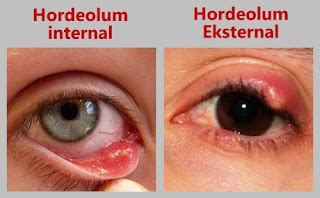 4 Natural ways to Cure Hordeolum ~ kesterluc