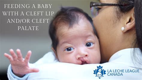 Feeding a Baby with a Cleft Lip and/or Cleft Palate | La Leche League Canada - Breastfeeding ...