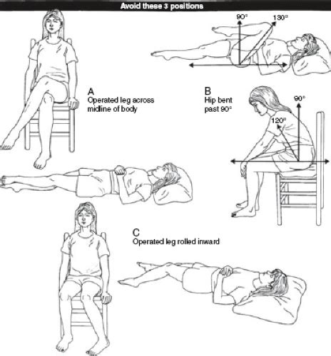 Anterior total hip replacement precautions | doctorvisit