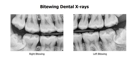 Bitewing radiograph is an intraoral x-ray showing the premolars and molars in a closed biting ...