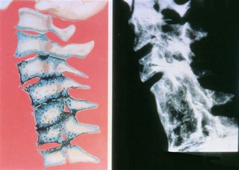 Neck Arthritis - Progressive Degeneration & How To Stop It