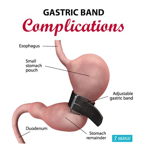 Gastric Banding (Lap-Band) Surgery Risks, Complications