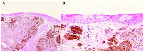 Histological findings of the lacrimal caruncle prior to topical ...