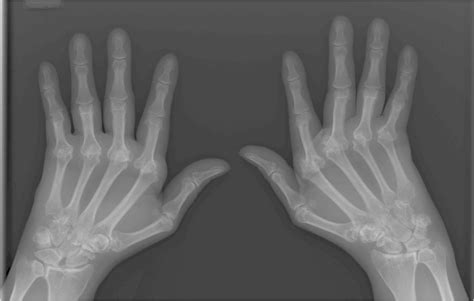 NIH Research Leads to New Rheumatoid Arthritis Drug – NIH Director's Blog