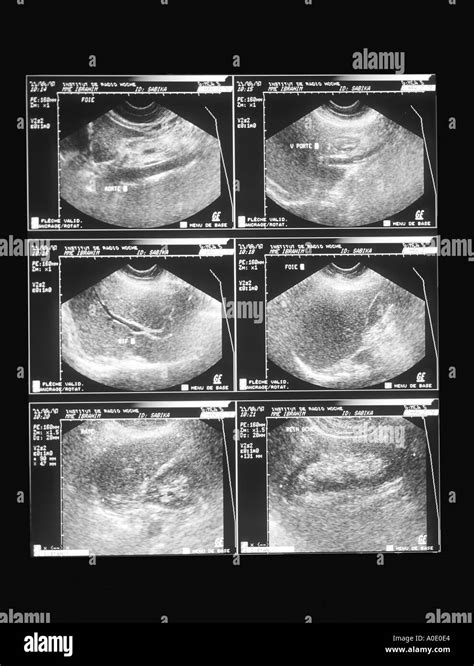 Abdominal Ultrasound Scan Stock Photo - Alamy