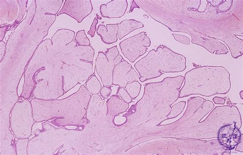 14.Breast (3) Malignant phyllodes tumor|Pathology Core Pictures