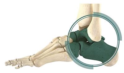 Triple Arthrodesis | Stryker