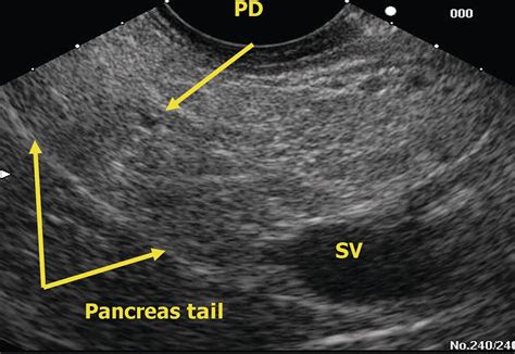 EUS of the Normal Pancreas | Radiology Key